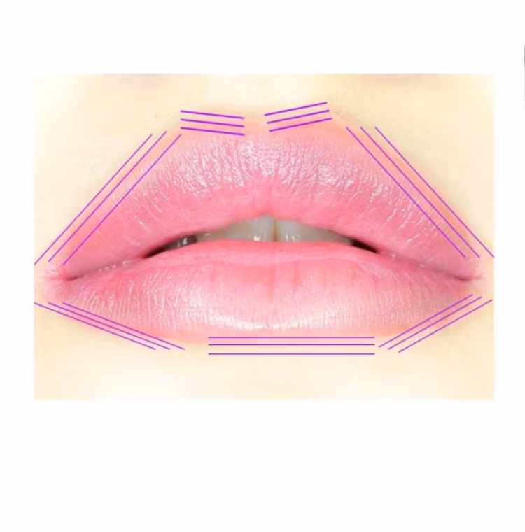 PDO-THREADS/PDO-TRÅDAR Barbie nose 10pack