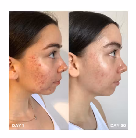 Clinisoothe skin purifier