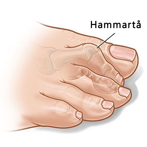 Hammertå bånd (2 stk.)
