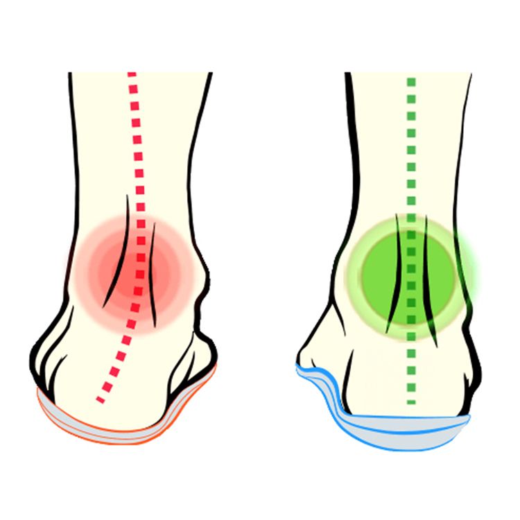 Skosål pronation