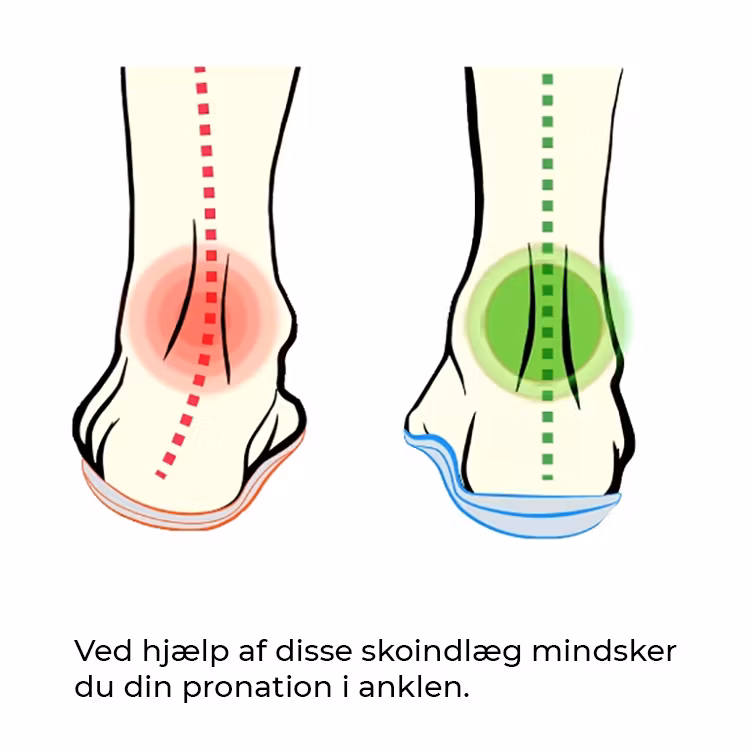 Skoindlæg pronation