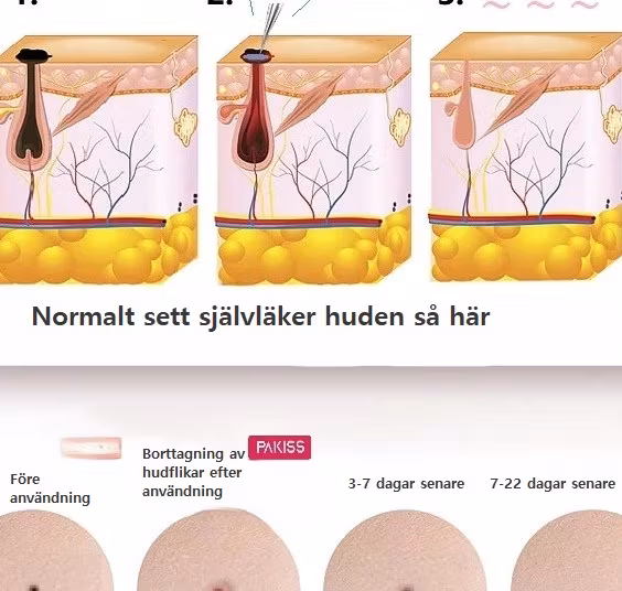 Hudtagg Tatuering Vårta Borttagningspenna Laser Fräknarborttagare