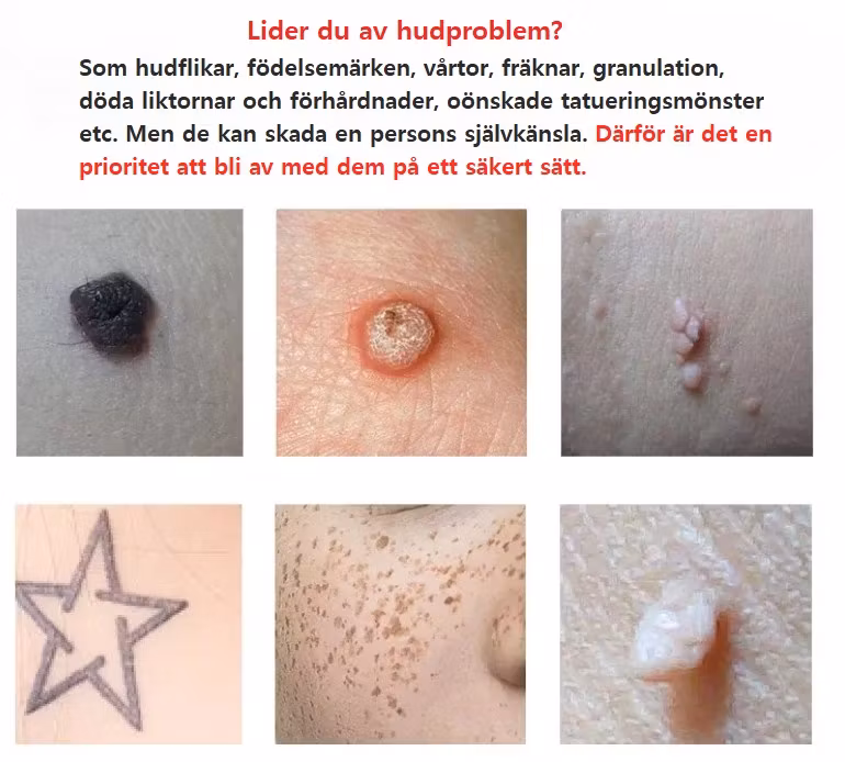 Hudtagg Tatuering Vårta Borttagningspenna Laser Fräknarborttagare