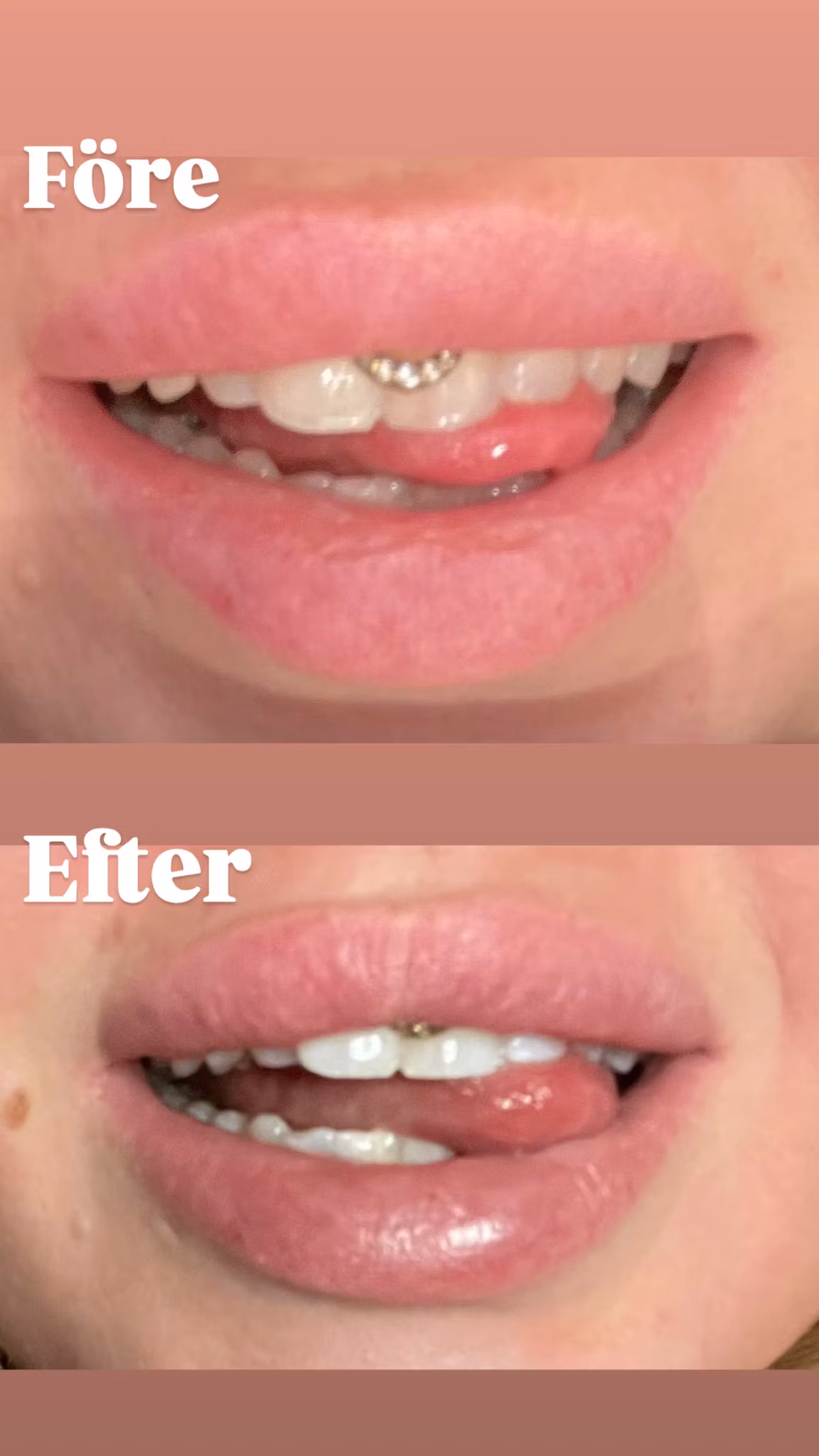 WeSmile Tandblekning startkit