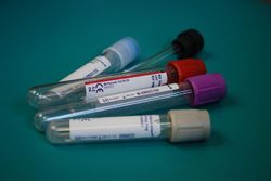 Hepatit ABC serologi - (Norvia 22)