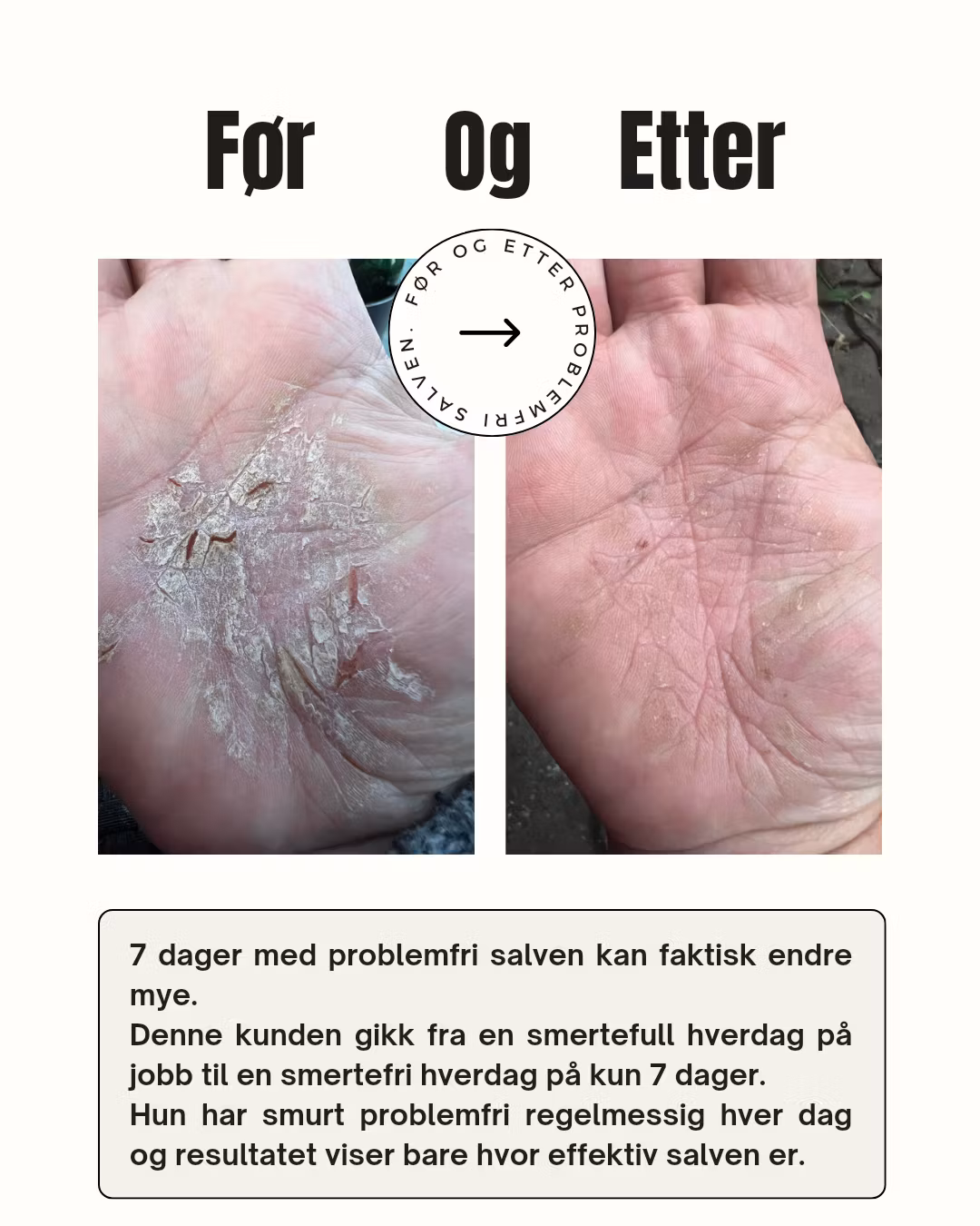 kontakteksem fikk god pleie av problemfrisalve