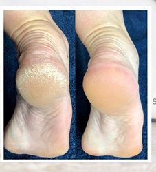Lova Skin Instant Foot Peeling Spray Bottle 75 ml