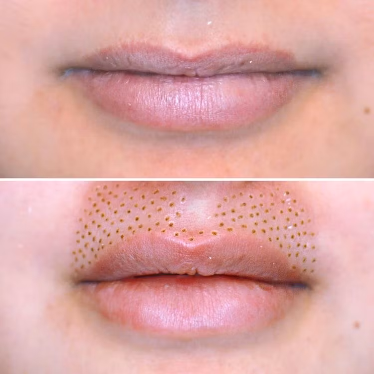 Utbildning i Plasma Pen inkl. maskin