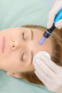 ONLINE KURS - Microneedling