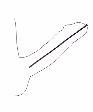 Spiral Dilator Set - Avancerad