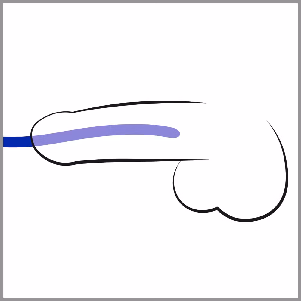 Silikon Dilator Set