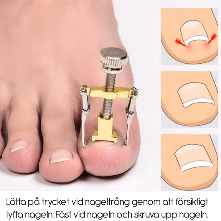 Ingegroeide teennagel (schroef)