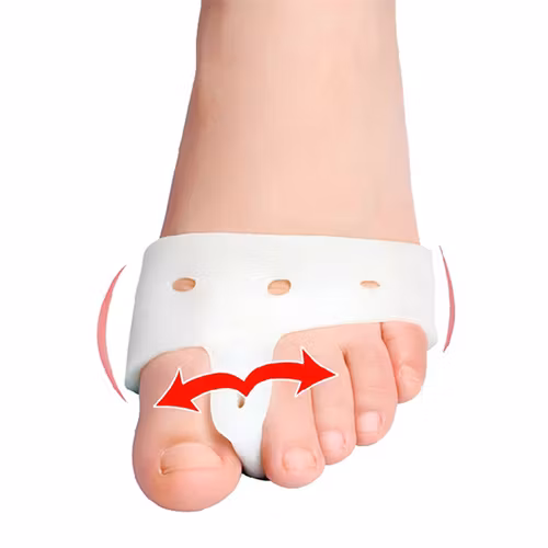 Hallux valgus (2 st.)