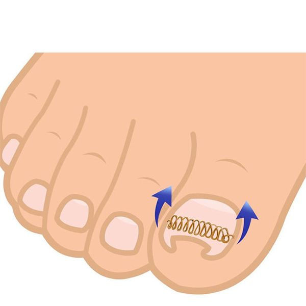 Ingegroeide teennagel (beugel)