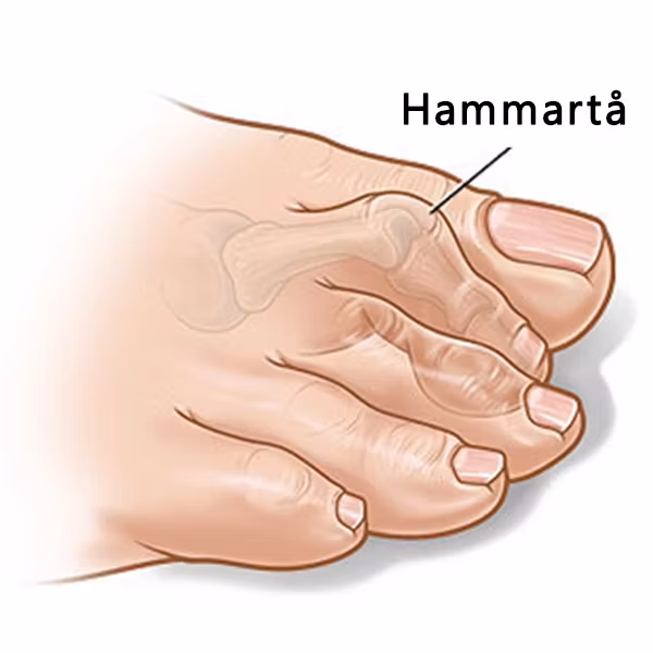 Hamerteentape (2 st.)