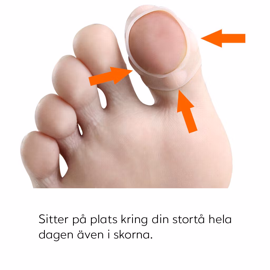 Inåtväxande nagel (Silikonskydd)