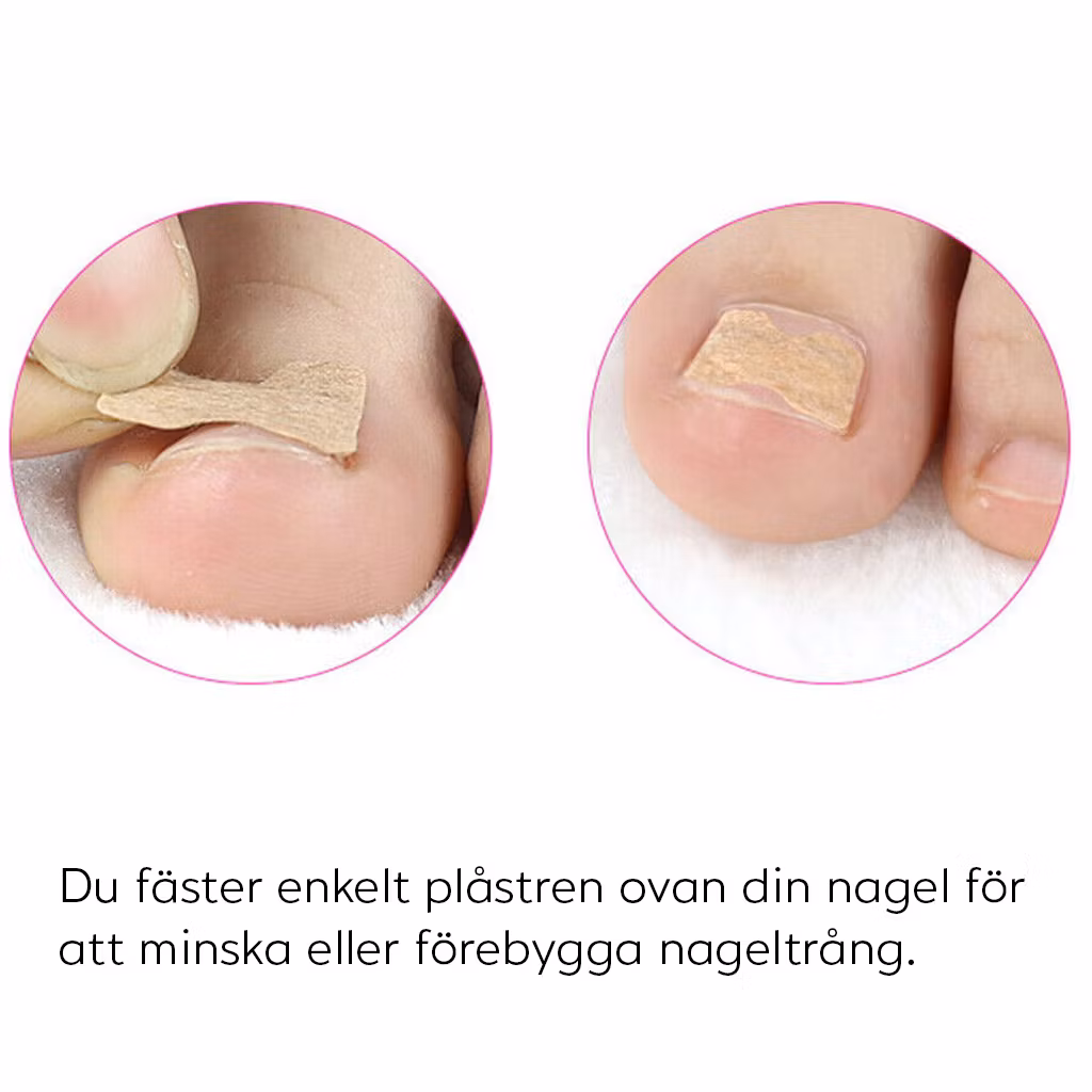 Plåster mot nageltrång (10st)