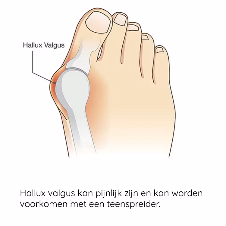 Hallux valgus siliconen bescherming