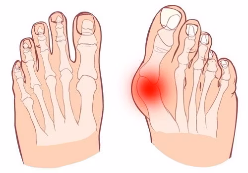 Fotproffsen.se > Hallux valgus