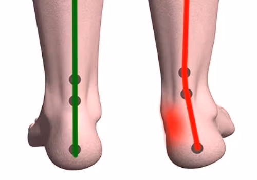Fotproffsen.se > Pronation