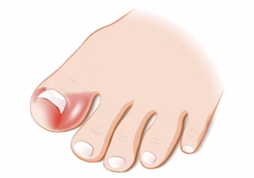 Fotproffsen.se > Nageltrång