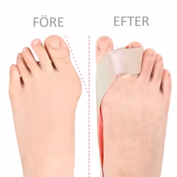 Hallux Valgus korrigerande band med tåseparerare BEIGE