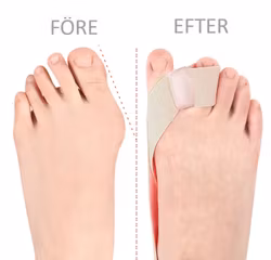 Hallux Valgus korrigerande band med tåseparerare BEIGE