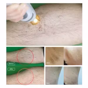 Alexandrite Nd Yag laser hårborttagningsmaskin
