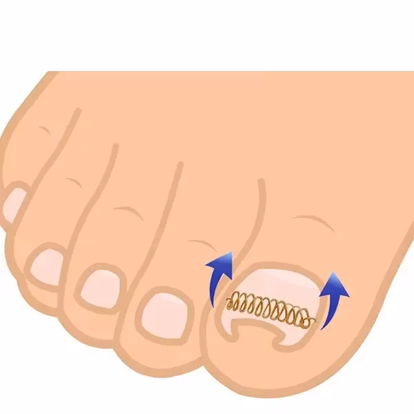 Nageltrång (bygel)