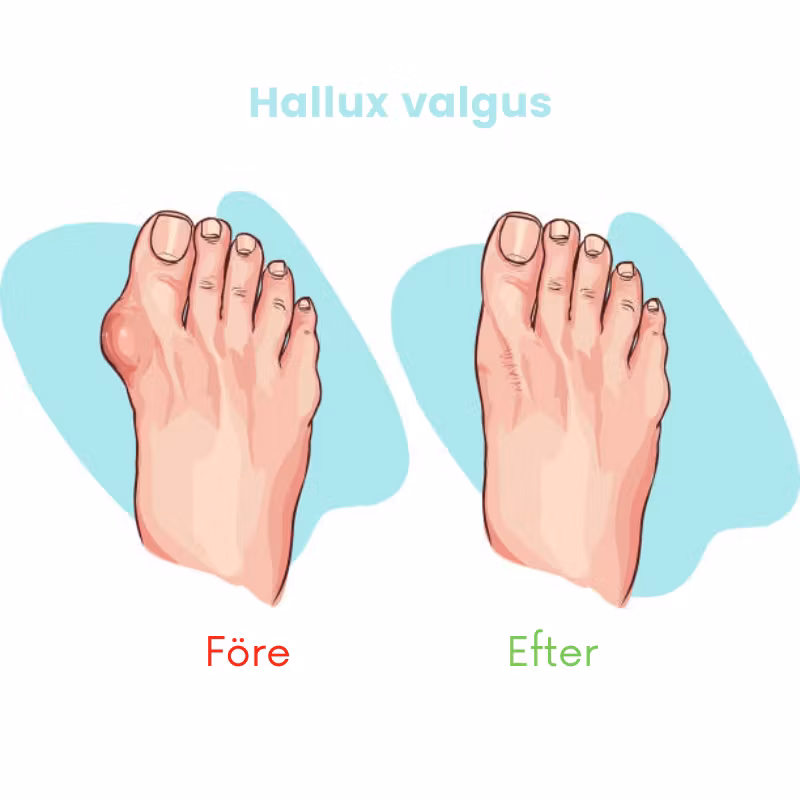 Tåspridare för Hammartå och Hallux valgus (2st)