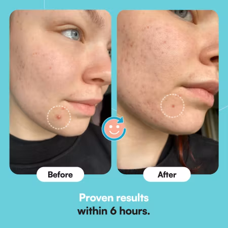 Pimple Patches Finnplåster 36 st