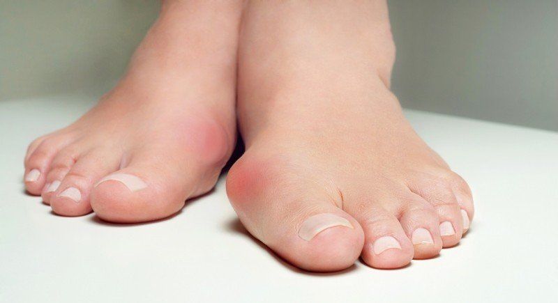 Hallux Valgus – Vad det är, Varför det uppstår och hur du lindrar besvären