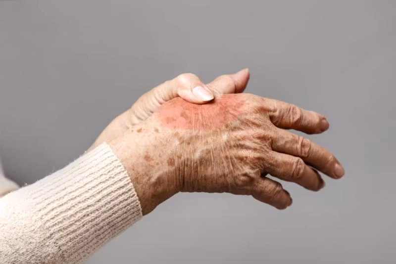 Artros – vad är artros, symtom, orsaker, diagnos och behandling