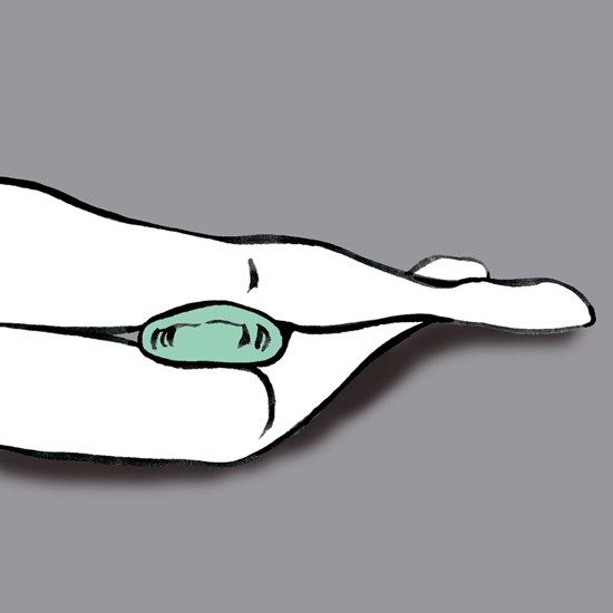 Stödring - Rhombo-Fill