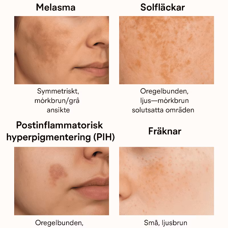 Hur ska du veta vilka pigmenteringar du har och hur ska du behandla dessa?