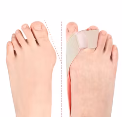 Hallux Valgus korjausnauha varpaiden erottimella BEIGE
