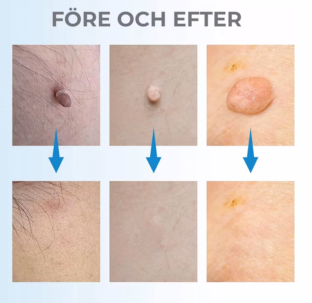 Ta bort hudflikar och födelsemärken hemma – enkelt och naturligt