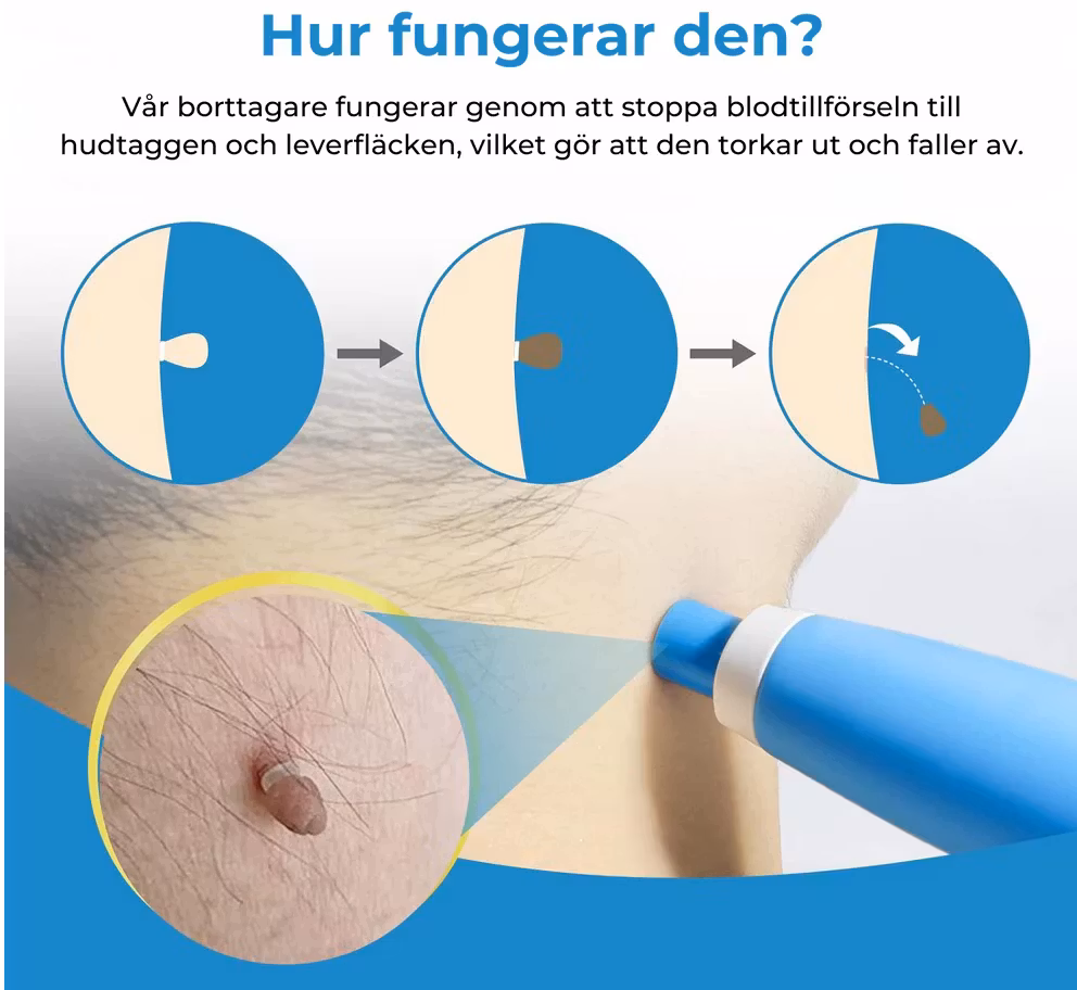 Ta bort hudflikar och födelsemärken hemma – enkelt och naturligt