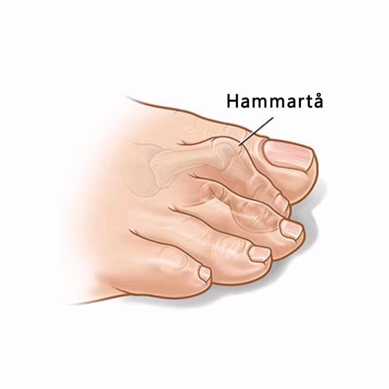 Tåspreder for hammertå og hallux valgus (2 stk)
