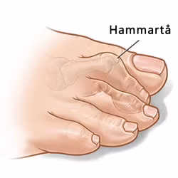 Hammertåbånd (2 stk)