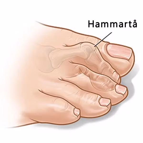 Hammertå forfot (2 stk)